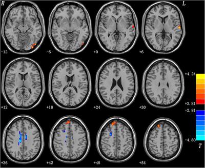 Abnormal Spontaneous Brain Activities of Limbic-Cortical Circuits in Patients With Dry Eye Disease